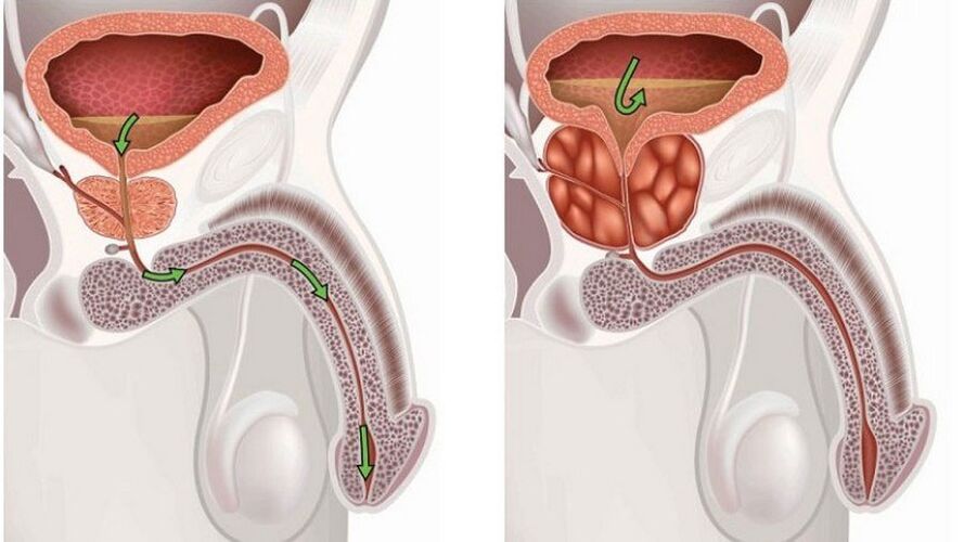 Prostatitis bei Männern