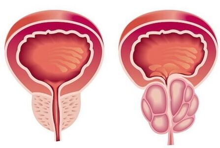 Prostatitis Symptome bei Männern